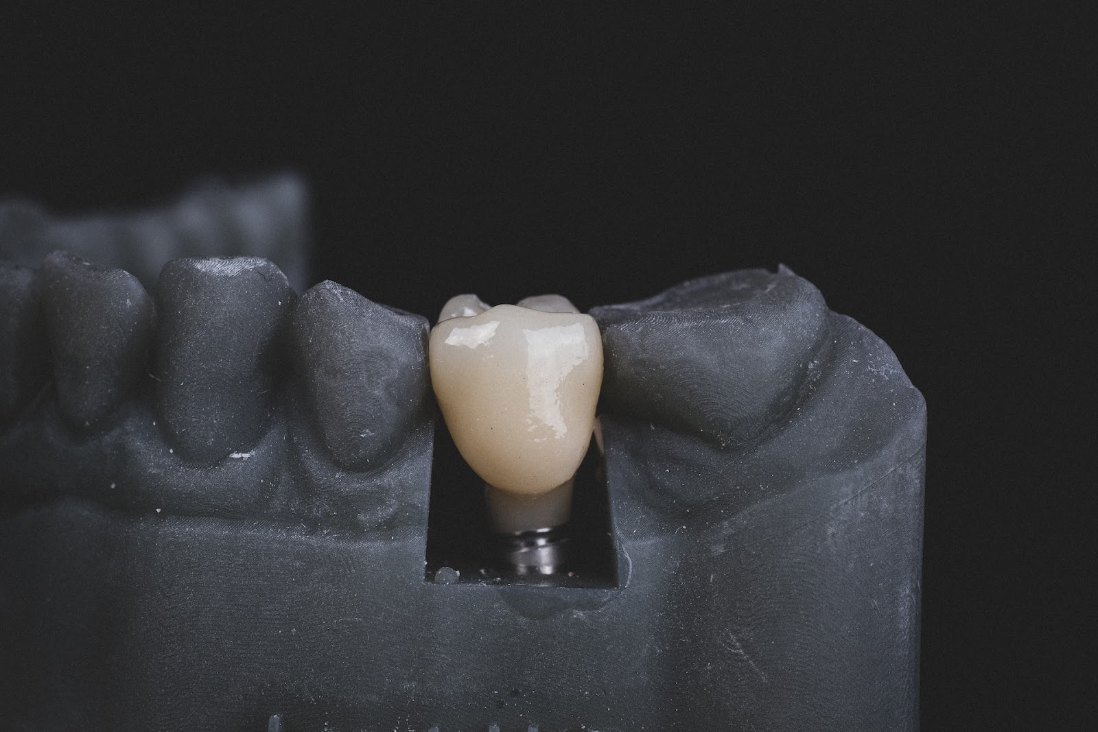 What Are Dental Crowns?