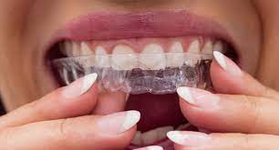 Common Myths About Teeth Aligners Busted!